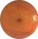 buraco macular